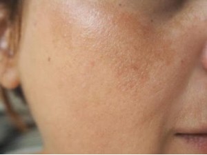 الكلف وتصبغات البشرة، الأسباب وطرق العلاج