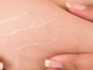 تشققات البطن اثناء الحمل