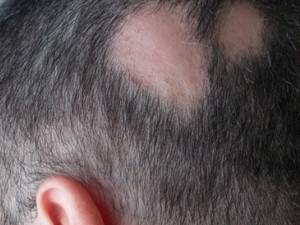 علاج الثعلبة نهائيا في الشعر والذقن والحواجب